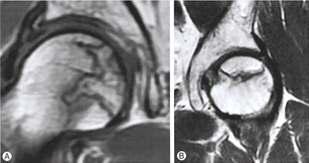 MRI